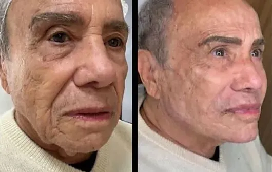 Stênio fez harmonização e aplicação de botox em diversas partes do rosto