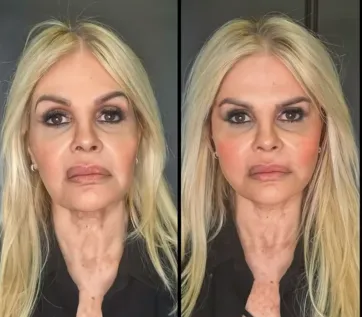 Monique Evans compartilhou resultado de harmonização facial