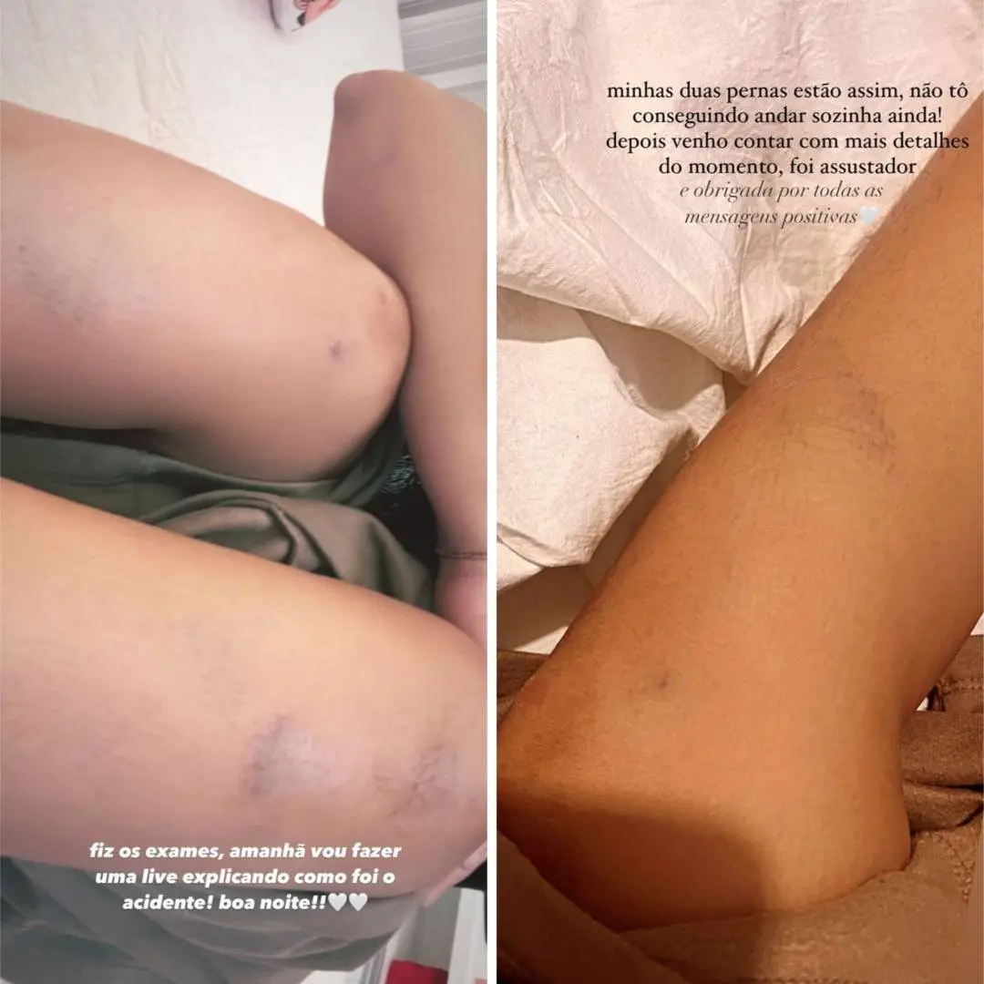 Brisa Star mostra ferimentos após acidente de ônibus