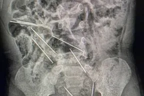 As agulhas no corpo da criança estavam em diversos locais do intestino, próximo a bexiga e outros