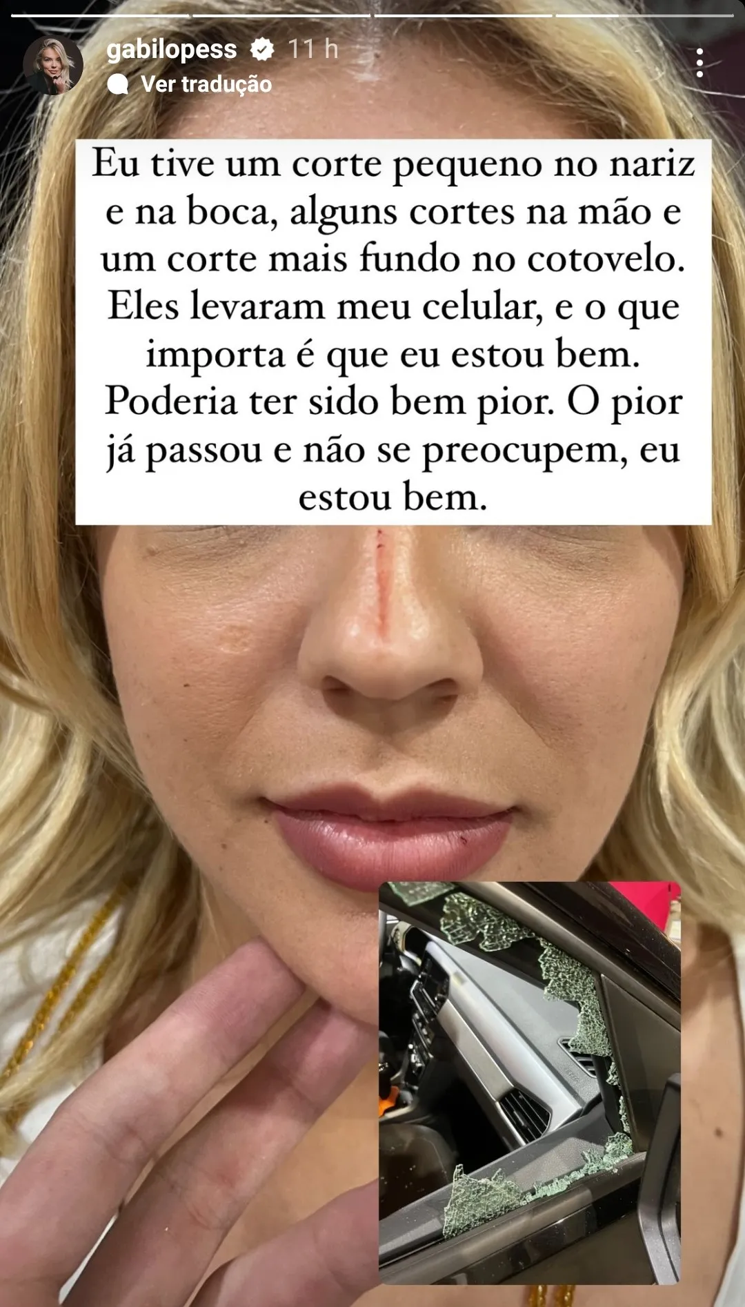 Artista sofreu apenas ferimentos leves