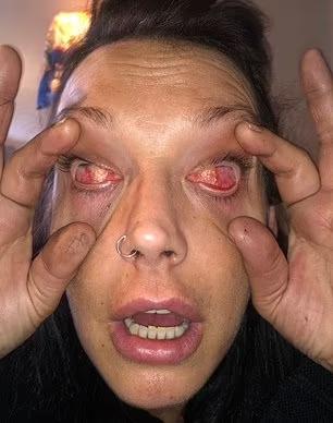 Foto de mulher com olhos infectados por detergente