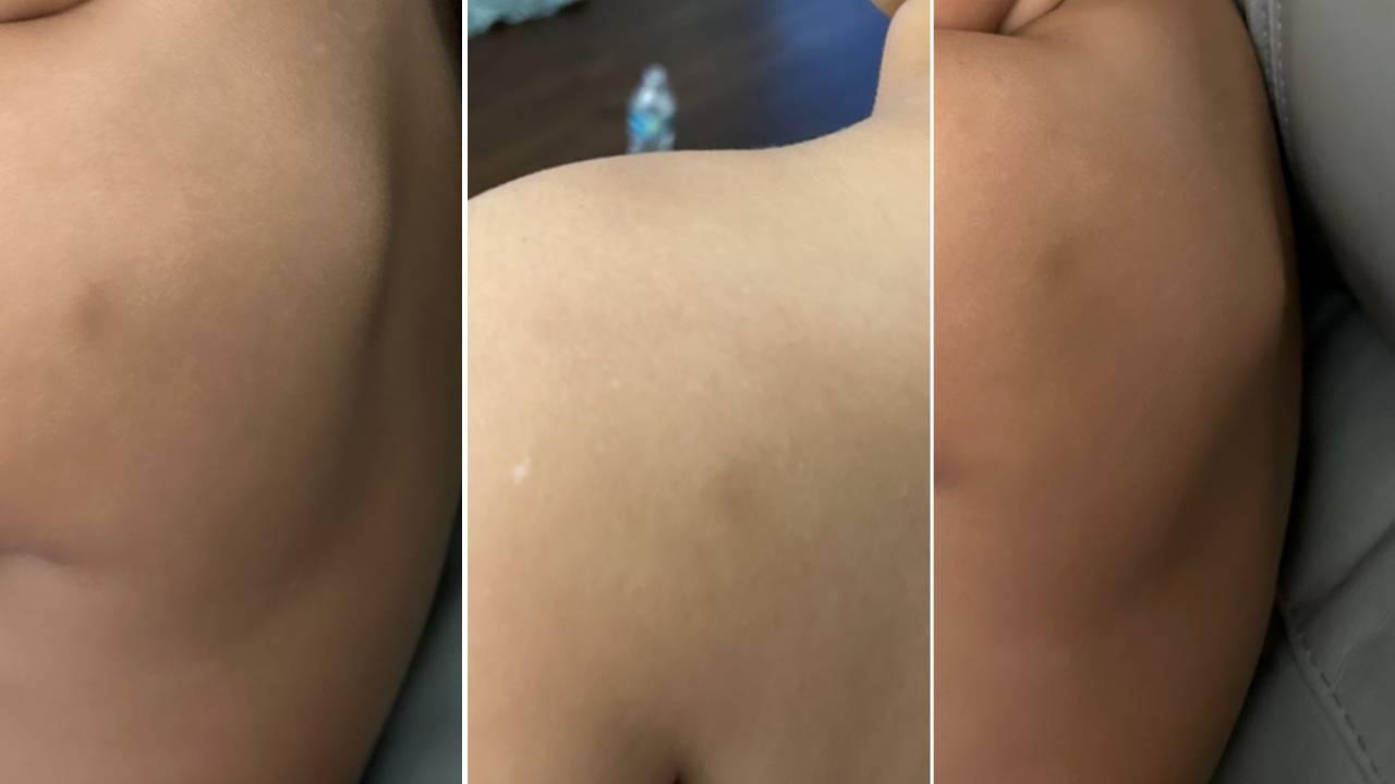 Montagem mostra três imagens de costas de criança com hematoma. Criança com autismo cearense é agredida por professora nos Estados Unidos.