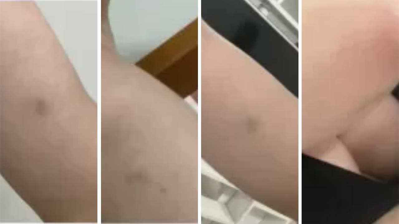 Naiara Azevedo mostra hematomas de suposta agressões do ex-marido