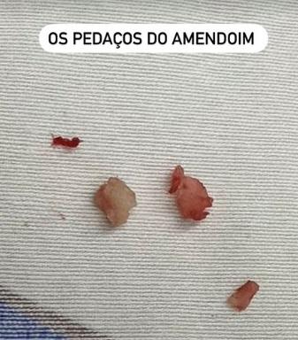 Amendoim retirado de pulmão da filha mais velha de Bárbara Evans