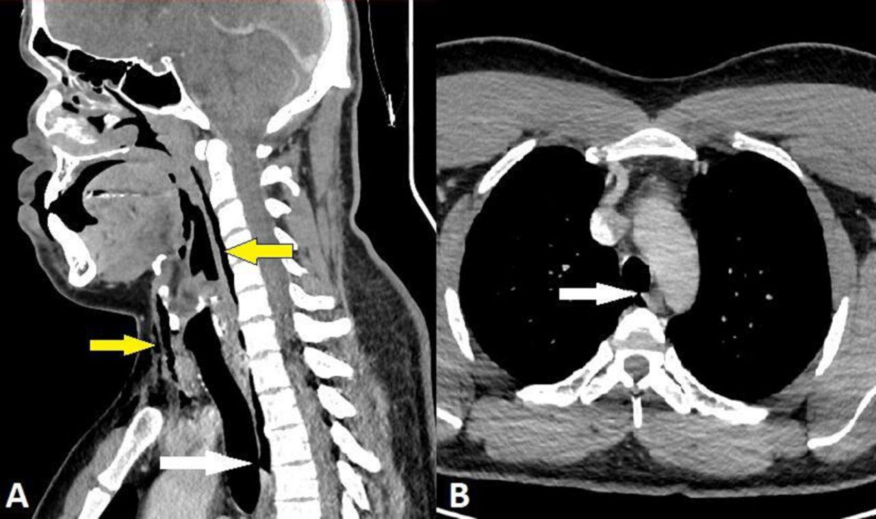 Imagem mostra imagens gerada por tomografia que mostrou perfuração na traqueia de paciente que teve órgão perfurado após segurar espirro