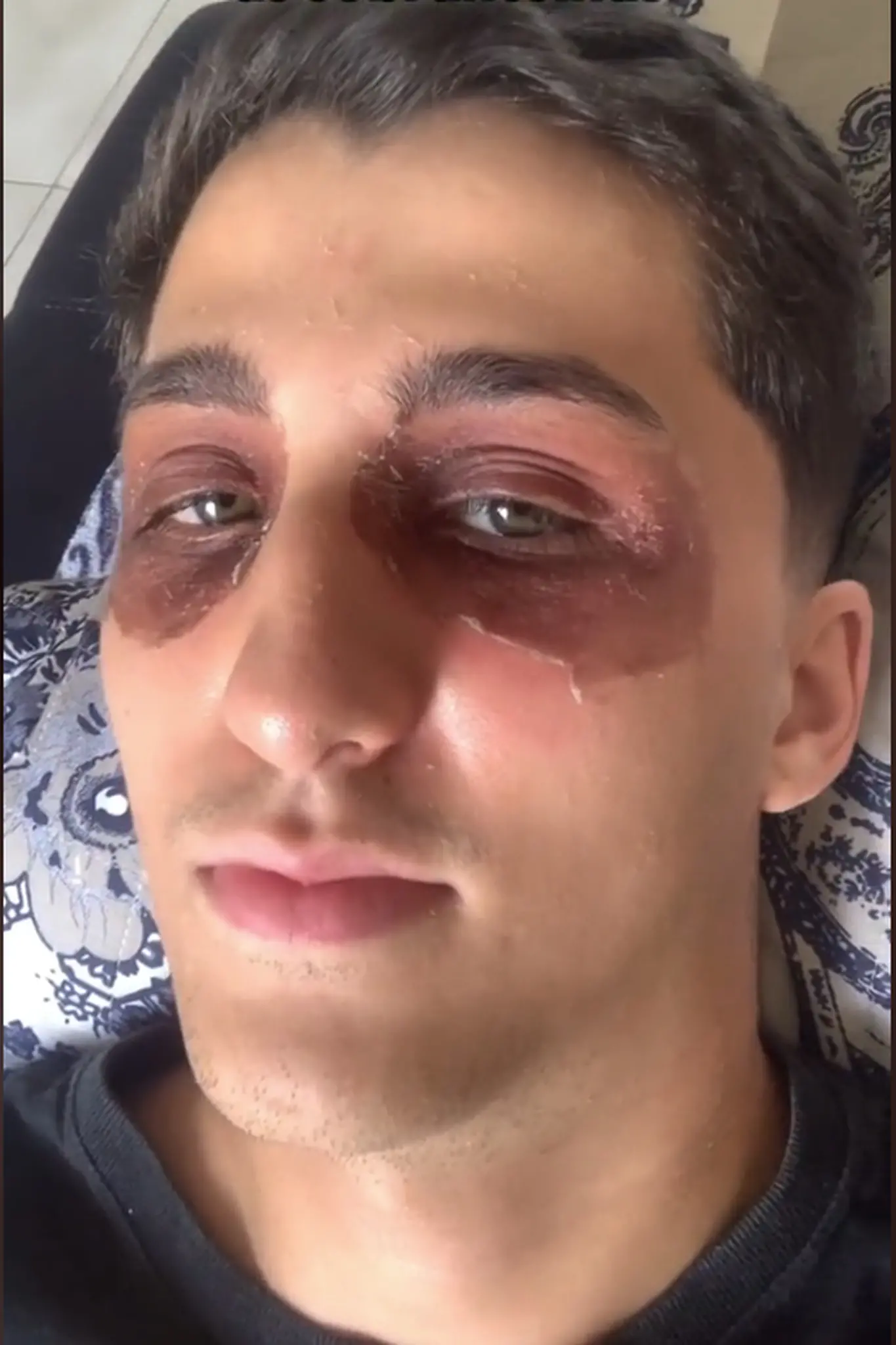 Jovem mostrando seus olhos com hematomas