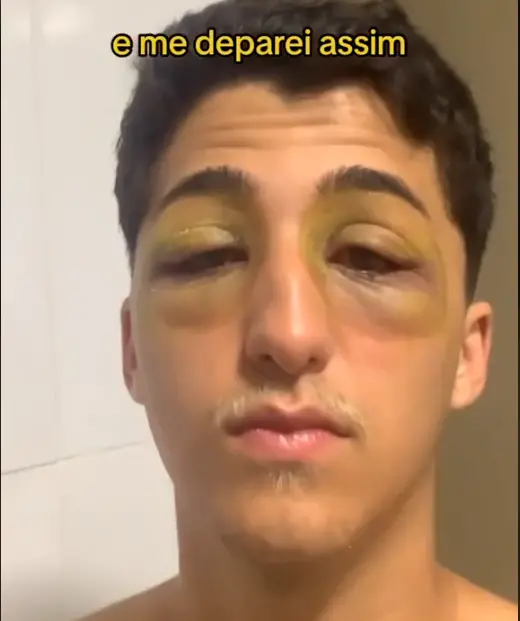 Jovem mostrando seus olhos com hematomas
