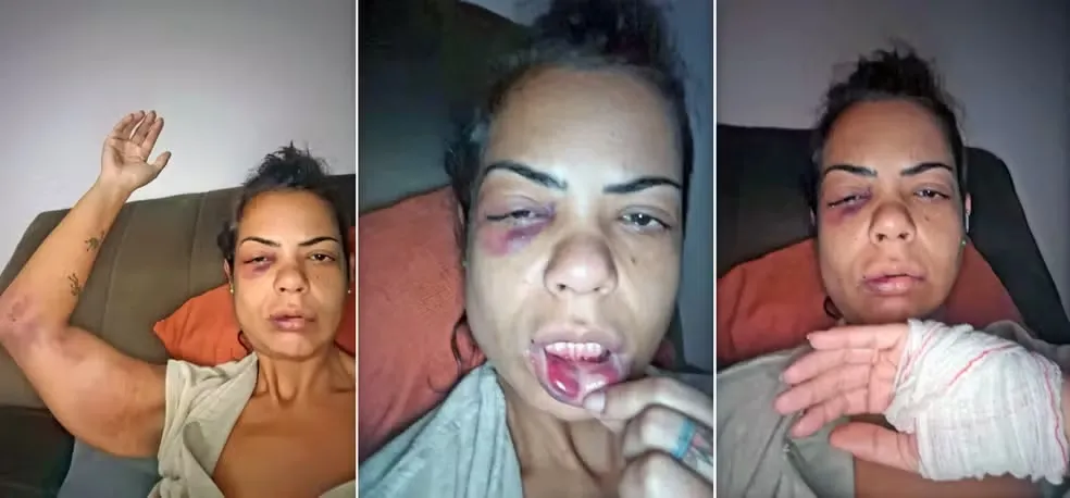 Diana ficou com vários hematomas pelo corpo