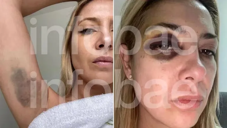 Yañez com hematomas no rosto e no braço