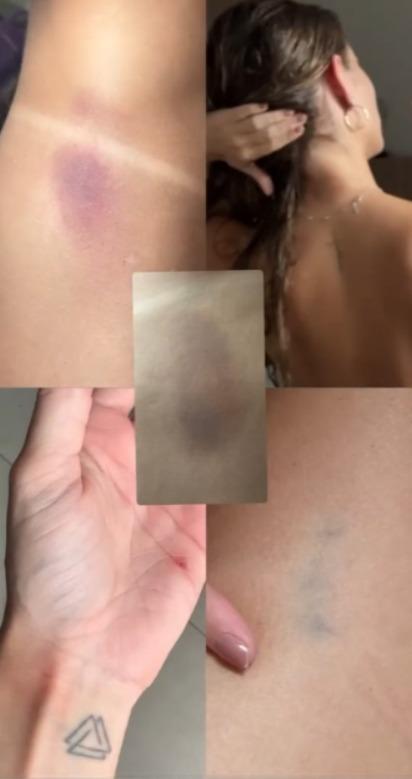 Hematomas. Modelo denuncia ter sido agredida por companheiro em apartamento na zona nobre de Fortaleza