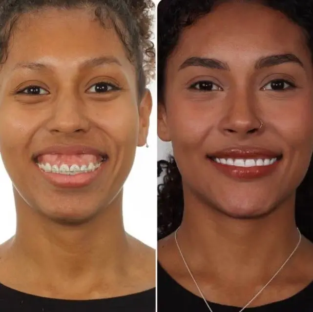 Imagem mostrando a diferença entre antes e depois de um tratamento estético. Giovanna à esquerda possui aparelho e pele sem maquiagem, enquanto à direita, após a cirurgia, está sorrindo e com uma leve maquiagem leve.