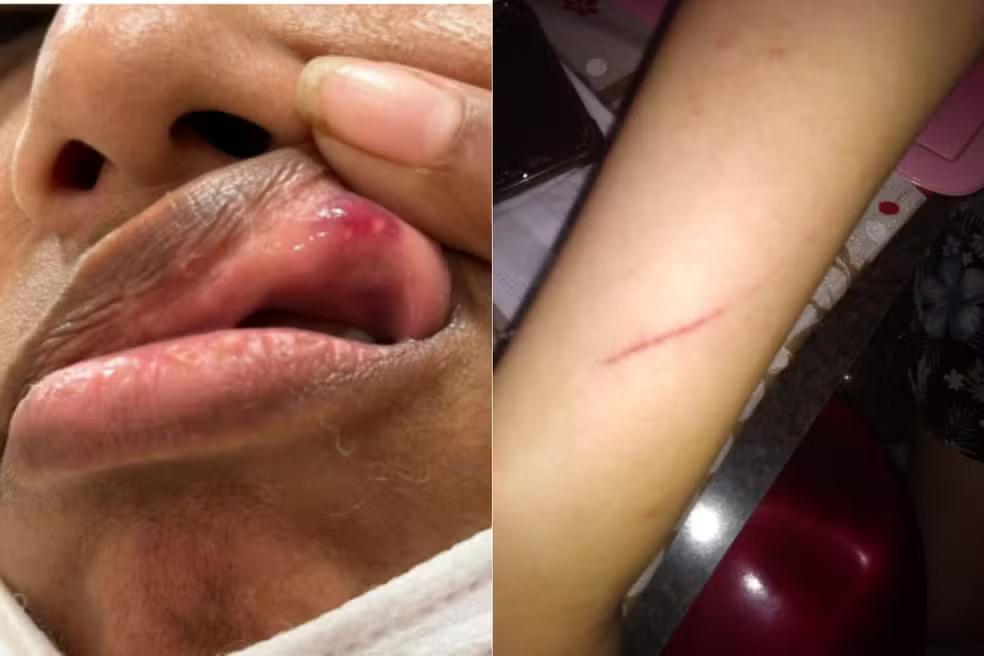 Imagem mostrando ferimentos na boca e no braço, evidenciando cuidados com lesões e o processo de cicatrização.