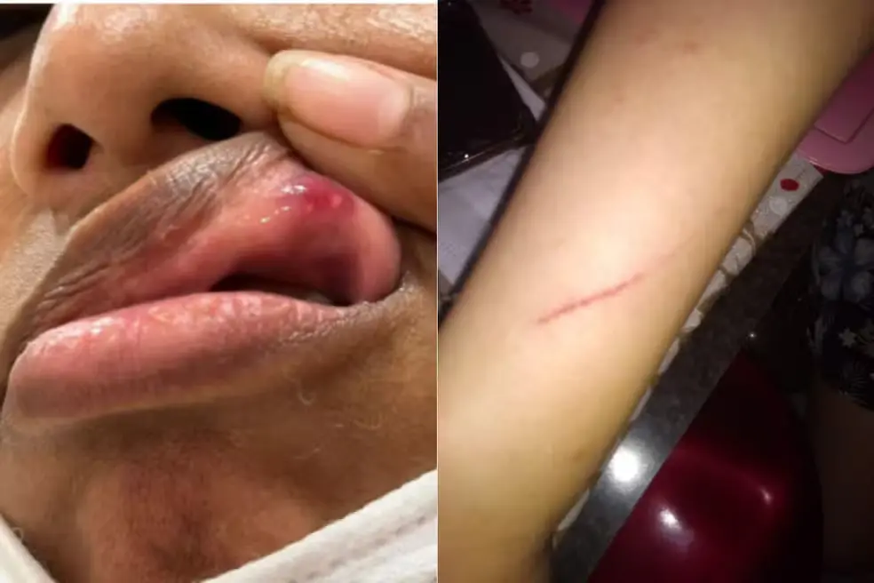 Imagem mostrando ferimentos na boca e no braço, evidenciando cuidados com lesões e o processo de cicatrização.