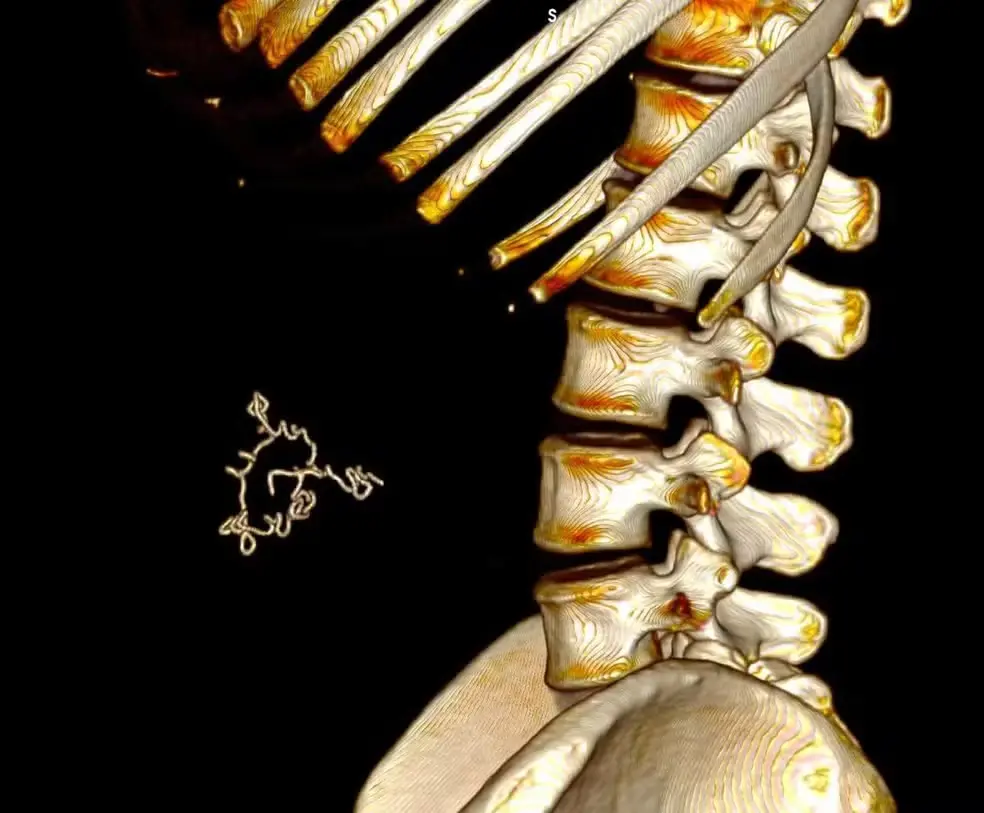 foto de raio x de Tatiane Freitas, que teve compressa hospitalar esquecida no abdômen