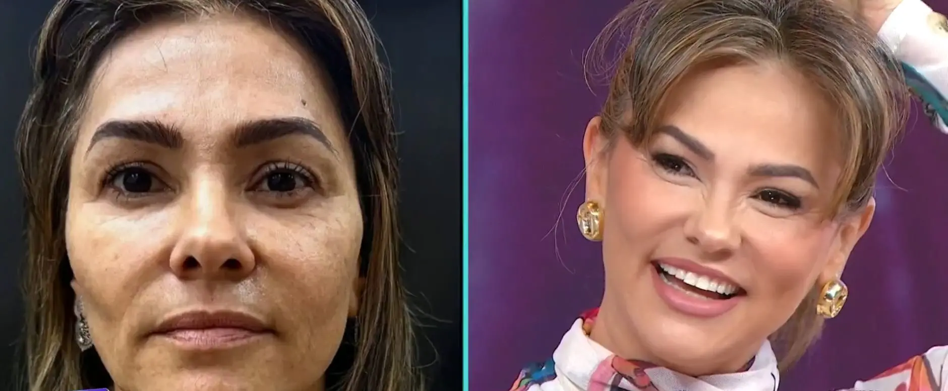 Antes e depois da harmonização facial de Suzana Alves, a Tiazinha, revelada ao vivo no programa Fofocalizando, do SBT