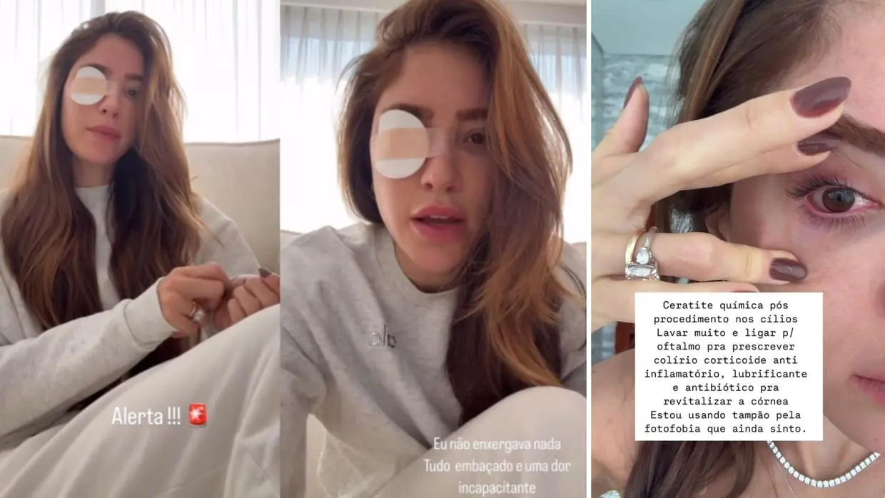montagem de Romana Novais mostrando efeitos da ceratite química após procedimento estético nos cílios