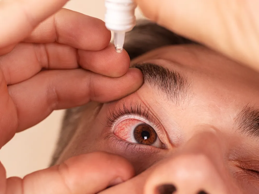 O tratamento para a ceratite inclui colírios anti-inflamatórios, à base de corticoide, geralmente associados a um antibiótico