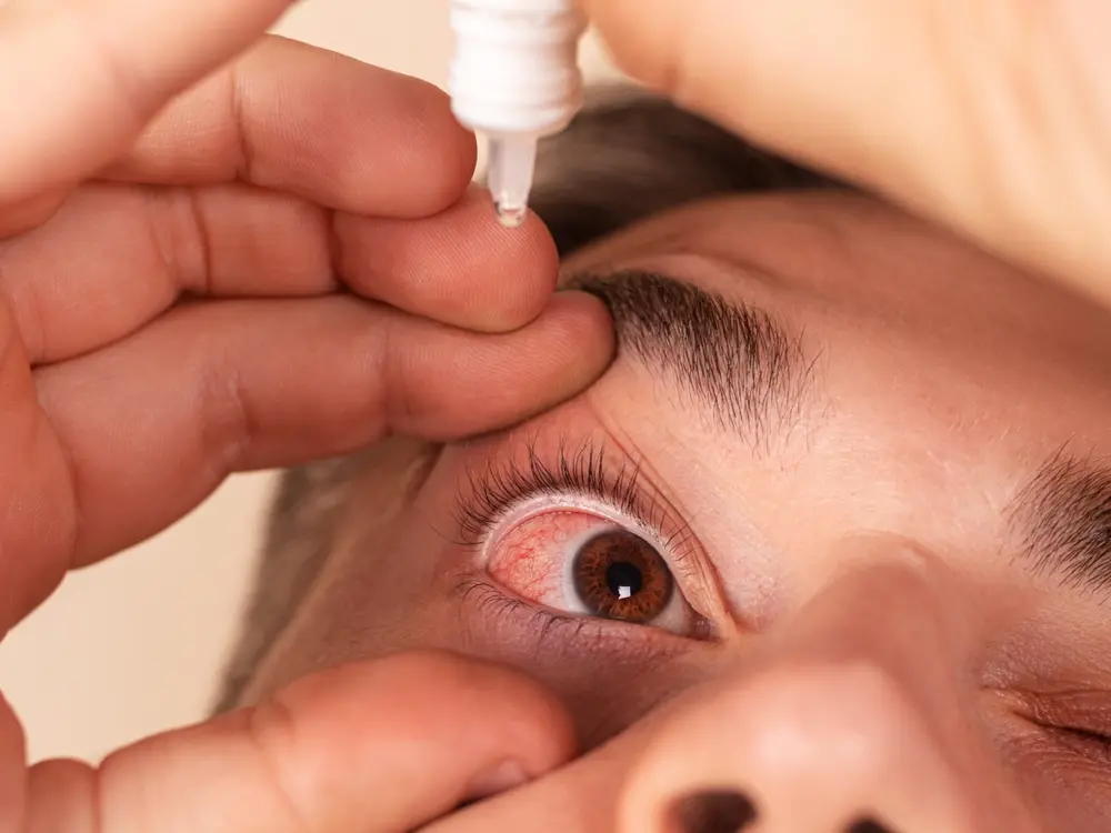 foto de homem colocado colírio no olho vermelho e irritado