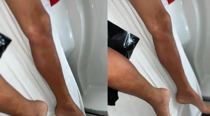 Imagem que mostra alergia no corpo de criança que tomou dipirona em Novo Oriente, no interior do Ceará