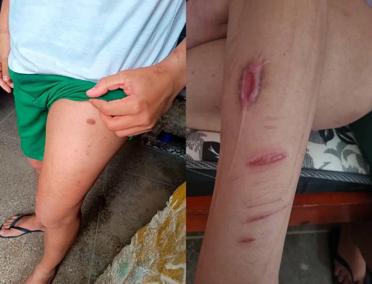 Marcas físicas em jovens internados em unidades socioeducativas