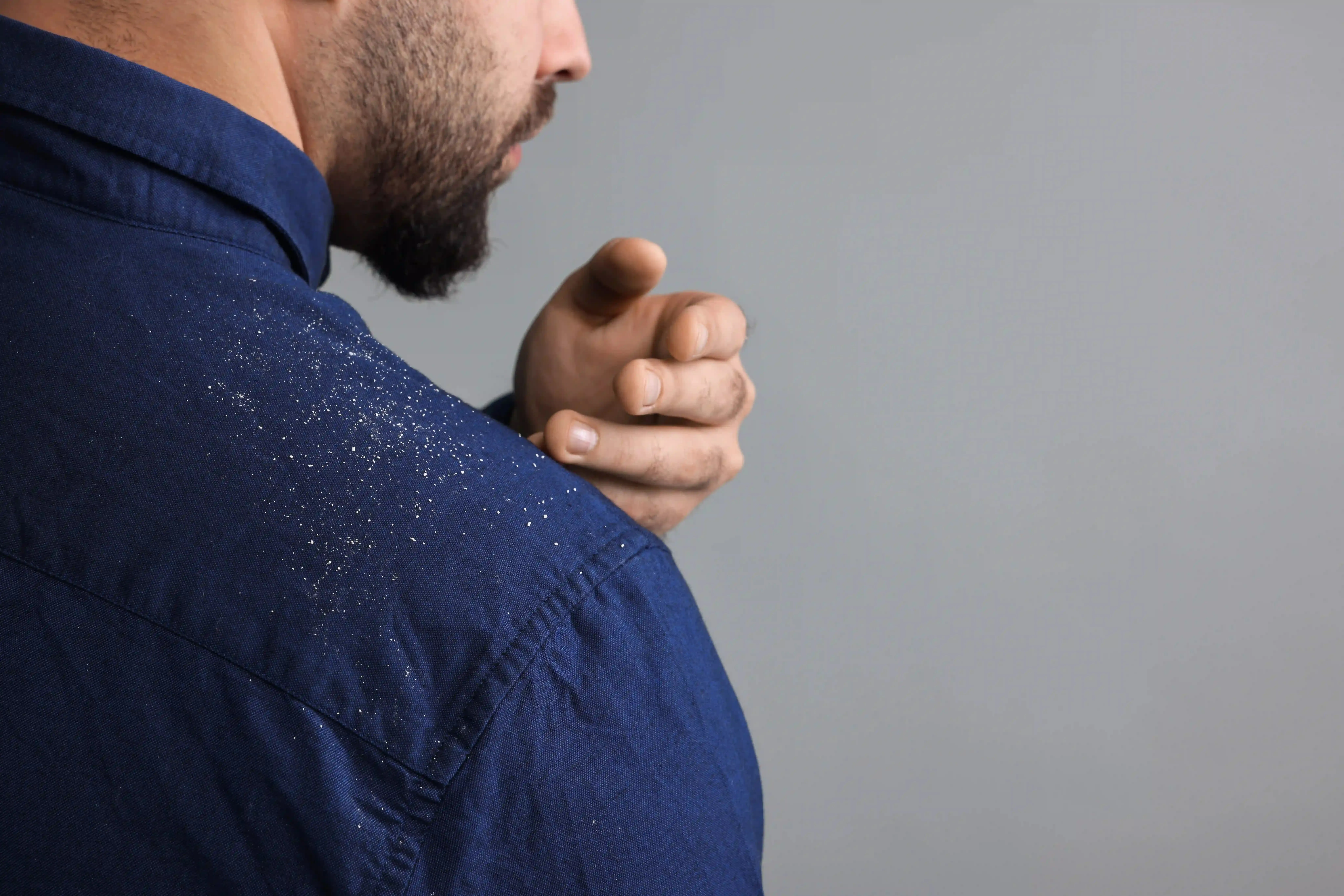 A caspa é conhecida por ser uma dermatite que causando coceira e dor, sendo identificada principalmente pelo 