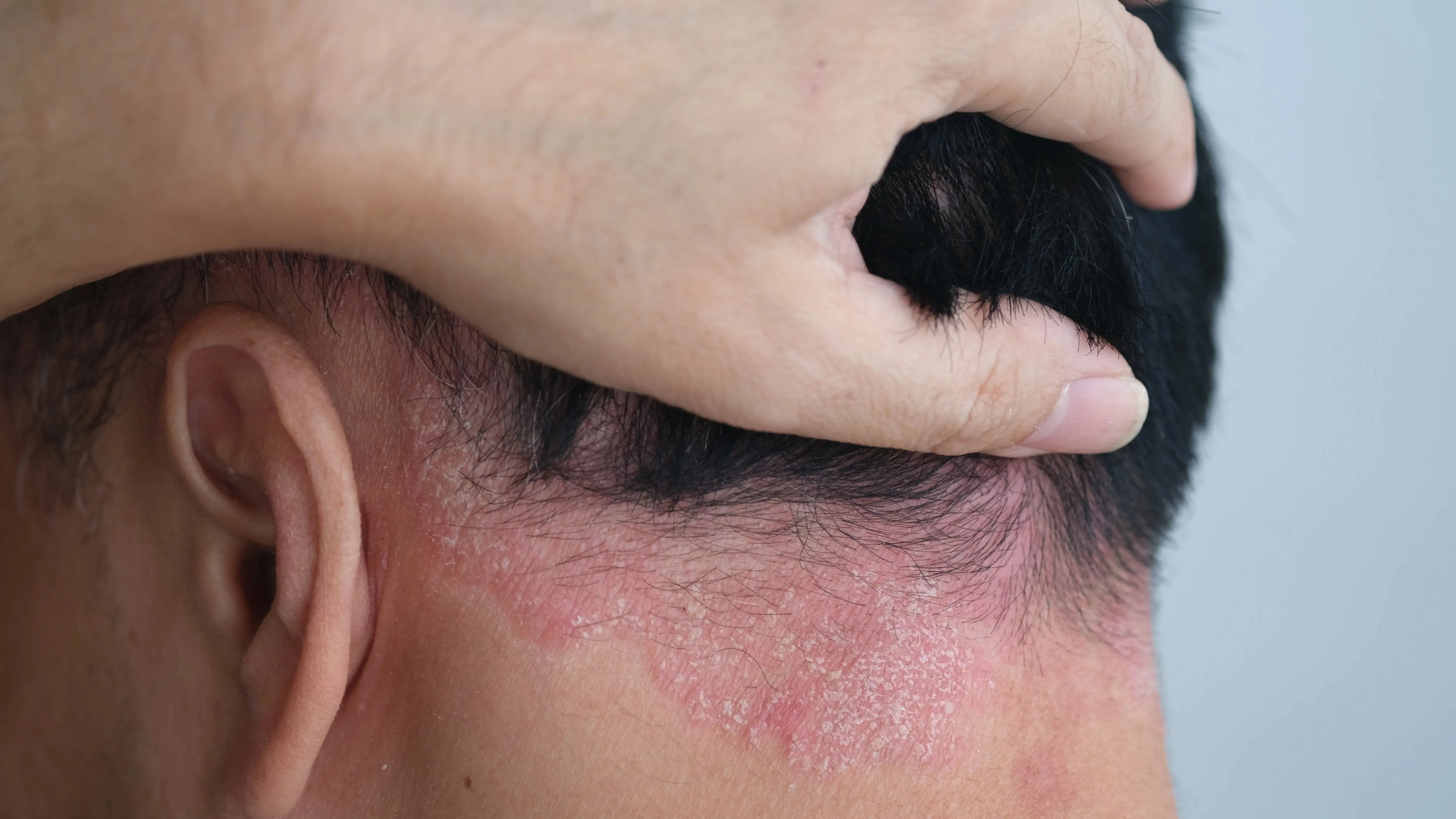 Pessoa com cabelo curto segurando fios com uma mão e deixando a mostra a psoríase para matéria sobre coceira na cabeça o que pode ser.