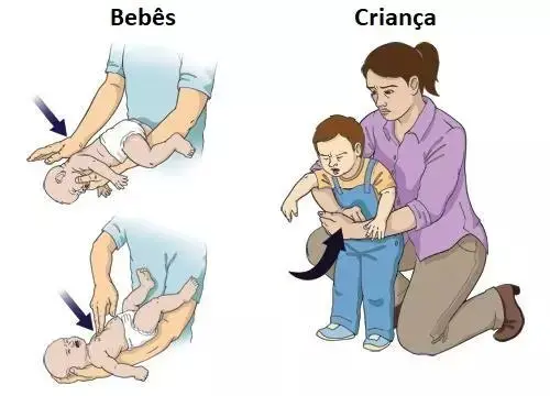 Imagem em desenho demonstrando a manobra de Heimlich