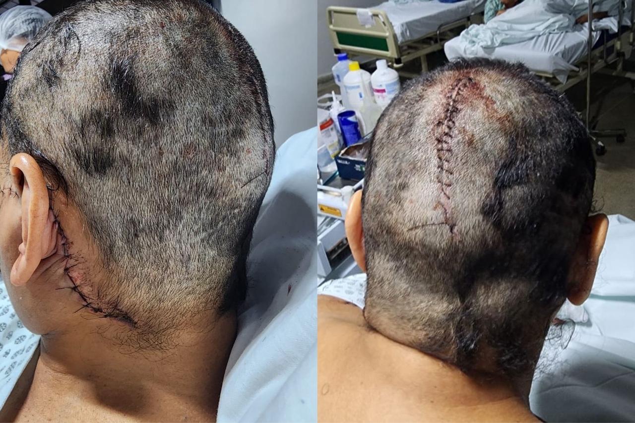 Mulher cortada com muitos pontos.