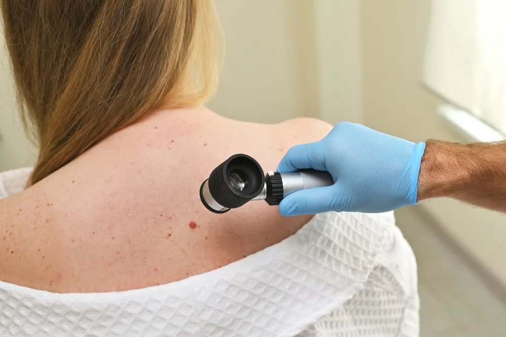 O exame de dermatoscopia é fundamental para a detecção precoce da doença.