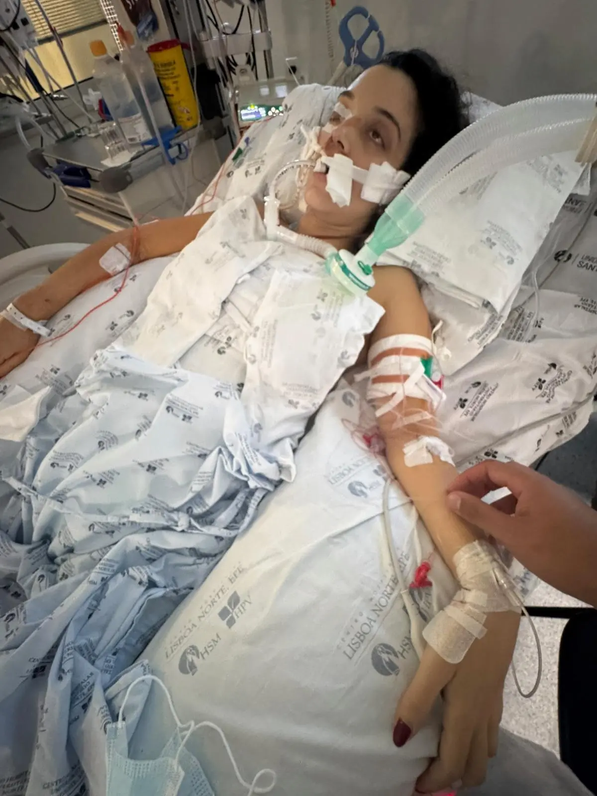 Na imagem, fotografia de Alana Barros em uma unidade de terapia intensiva hospitalar após o parto. Ela está deitada em um leito, vestindo uma bata azul clara e coberta por lençóis brancos com o logotipo do Centro Hospitalar Universitário Lisboa Norte. Alana está entubada e conectada a um ventilador mecânico por meio de tubos brancos e verdes presos ao rosto com fitas adesivas médicas. Seus braços apresentam diversos acessos venosos, curativos e bandagens. No canto inferior direito, vê-se a mão de outra pessoa tocando suavemente o braço de Alana, em um gesto de apoio. O fundo mostra monitores cardíacos e equipamentos médicos típicos de uma UTI.