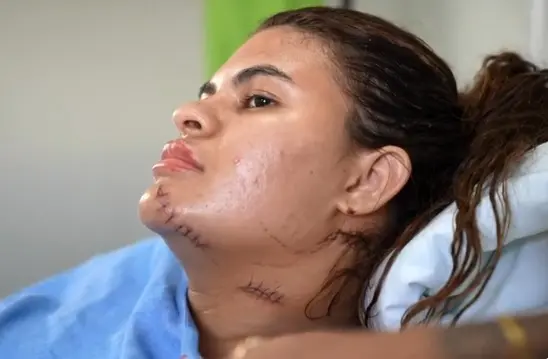 Ana Clara, vítima de tentativa de feminicídio mostra marcas do ataque