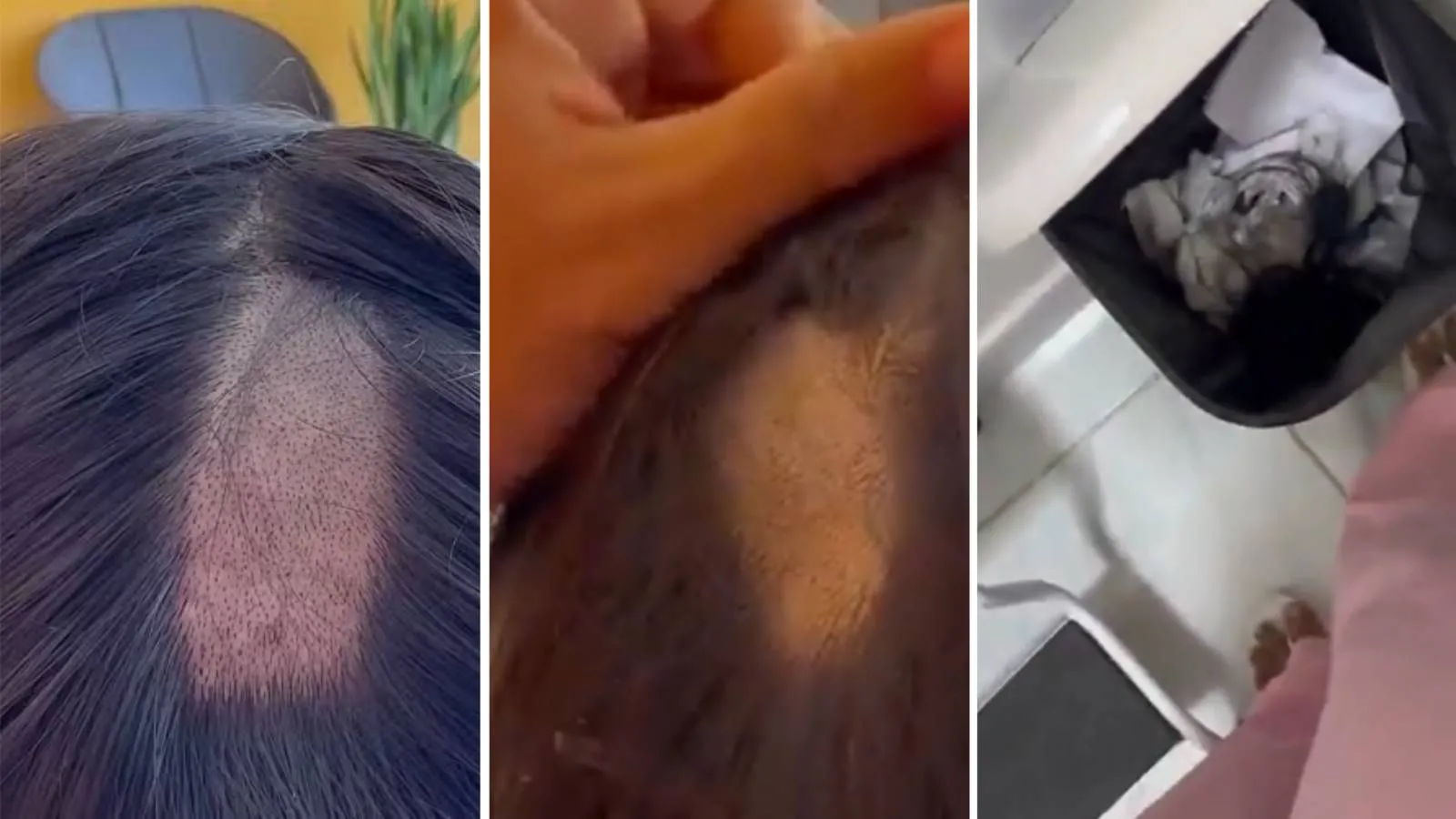 Jovem disse que mudou o penteado para tentar esconder as falhas.