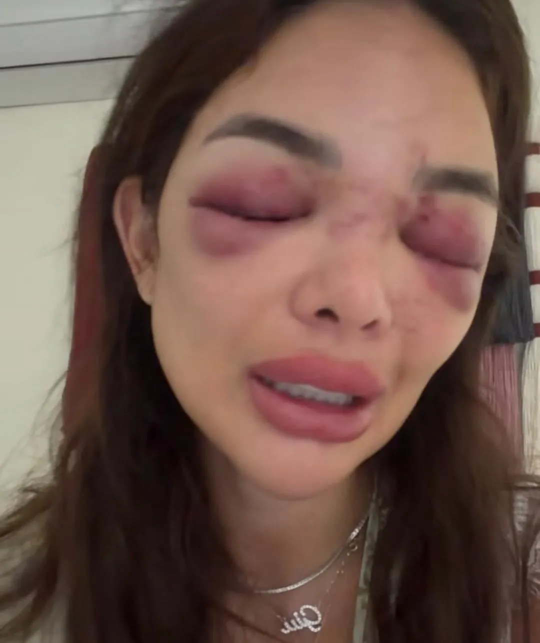 Giullia Falcão Kos apareceu nas redes sociais com o rosto machucado após agressões.