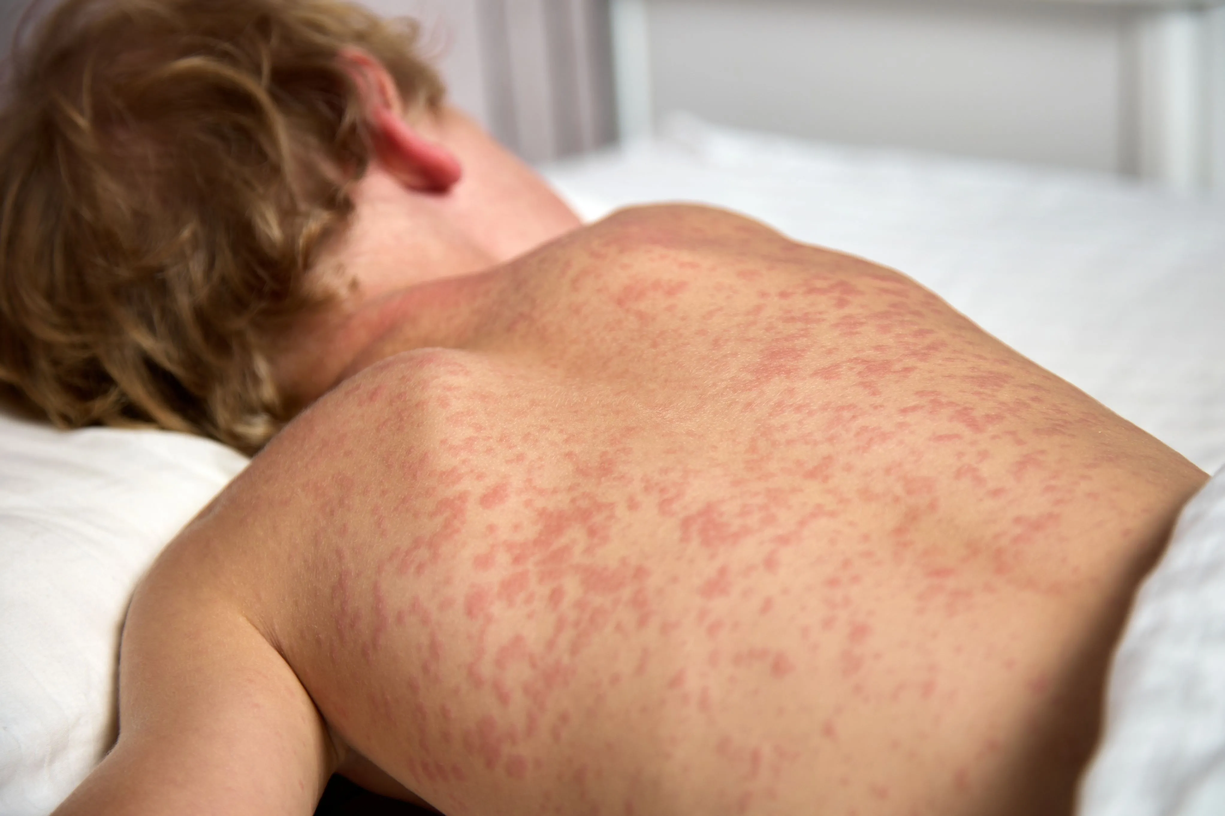 Além do risco de morte, o sarampo pode deixar sequelas por toda a vida, tais como pneumonia, otite média aguda e encefalite aguda.
